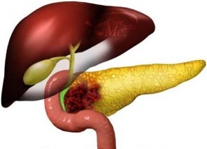 imagini cancerul pancreasului